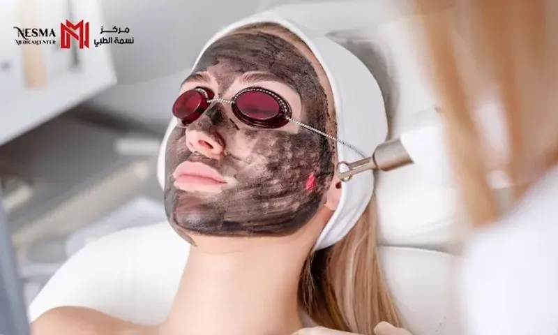 Advanced Carbon Laser Facial for a Refined & Radiant Complexion at Nesma Medical Center!