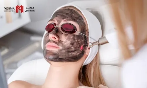 Advanced Carbon Laser Facial for a Refined & Radiant Complexion at Nesma Medical Center!