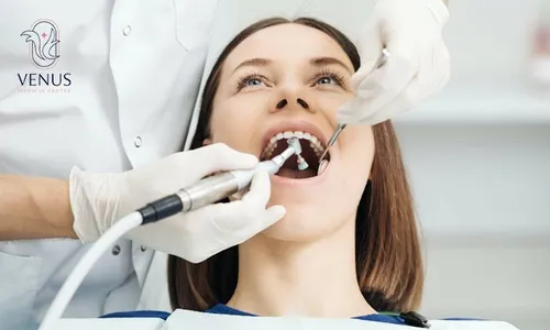 Dental Services: Teeth Whitening, Scaling, Polishing & Tooth Filling at Venus Medical Center!