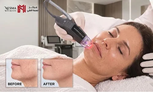 Ageless Skin Starts Here: Morpheus Skin Non-Surgical Remodeling Treatment!
