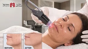 Ageless Skin Starts Here: Morpheus Skin Non-Surgical Remodeling Treatment!
