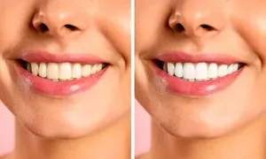 -al-hilal-premium-medical-center_dealimage_health-clinic_zoom-teeth-medical-2-copy.webp