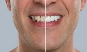 sultan-medical_dealimage_health-clinic_veneer-3-copy.webp
