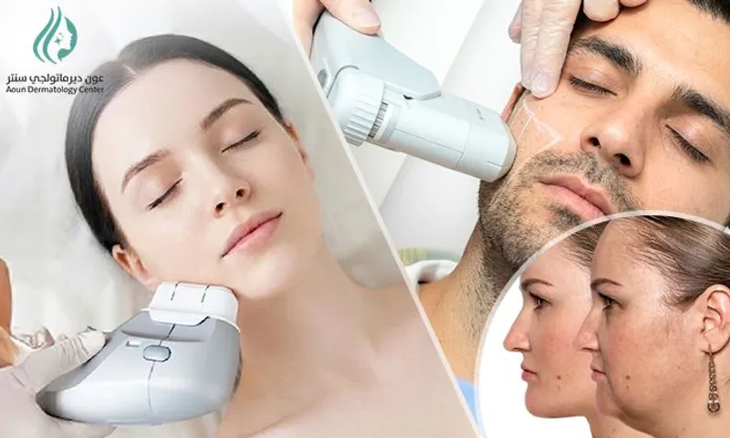 HIFU Skin Tightening for Ladies & Men at Aoun Dermatology Center!
