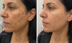 vlcc_-dealimage_healthandclinic_picosure-pro-laser-2-copy.webp