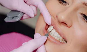 avenues-dental_-dealimage_health_acne-veneer-copy.jpg