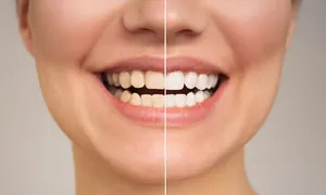 al-bidaa_dealimage_health-and-clinic_zoom-teeth-white-5-copy.jpg