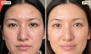 austin-medical-dealimage_health-clinic-_microneedling-prp-4.jpg