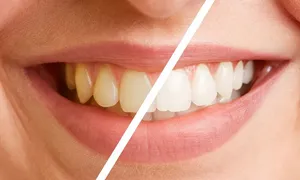 dafna-medical_-dealimage_health_scaling-teeth-3-copy.jpg