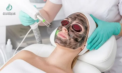 Deep Skin Brightening & Rejuvenation with Carbon Laser at Aoun Dermatology Center!