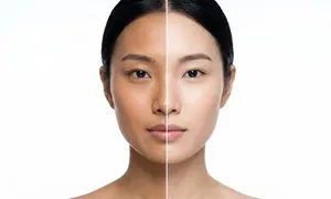 queens-derma_-dealimage_healthandclinic_carbon-laser-c2opy.jpg