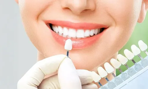 Revive Your Smile! Crowns, Dentures, or Veneers with FREE Consultation