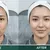 aoun-derma_dealimage_healthclinic_carbon-laser-3.jpg