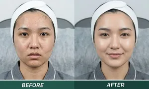 aoun-derma_dealimage_healthclinic_carbon-laser-3.jpg