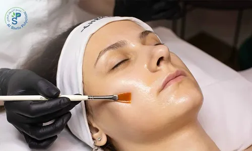 Instant Glow: Chemical Peel for Ladies & Men at Al Shefa Polyclinic!