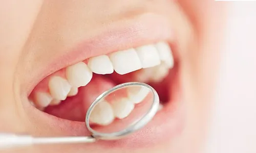 Composite Fillings and Veneers at Elegant Smile Dental Clinic!