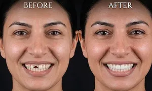zone-medical-centre_dealimage_health-clinic_dental-implant-3.jpg