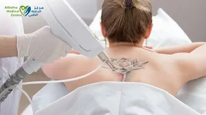 Laser Tattoo Removal at Al Dafna Medical Center!