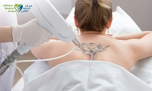 Laser Tattoo Removal at Al Dafna Medical Center!