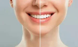 sultan-medical_dealimage_health-clinic_veneer-2-copy.webp