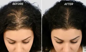 united-medical-center-_-dealimage_health_mesotherapy-hair-2copy.webp