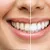_al-hilal-premium-medical-center_dealimage_health-clinic_dental-scaling-2-.jpg