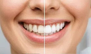 _al-hilal-premium-medical-center_dealimage_health-clinic_dental-scaling-2-.jpg