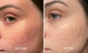 dafna-medical_-dealimage_health_fractional-laser-2-copy.webp
