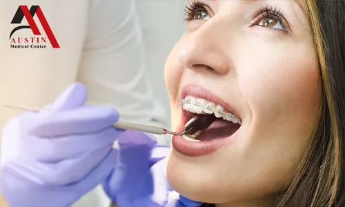 Metal Braces, Adjustment, Retainer & Consultation at Austin Medical