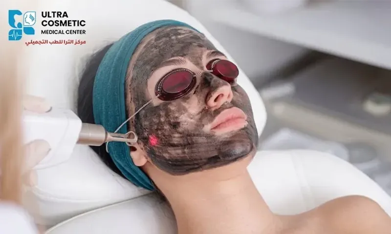 Carbon Laser Facial for Skin Purification & Rejuvenation at Ultra Cosmetic Medical Center!