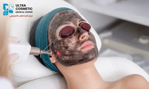 Carbon Laser Facial for Skin Purification & Rejuvenation at Ultra Cosmetic Medical Center!
