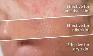 aoun-derma_dealimage_healthclinic_carbon-laser4.jpg