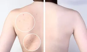 dafna-medical_-dealimage_health_acne-derma2-copy__02.jpg
