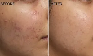 wellkins_dealimage_beautyspa_mesotherapy-1-copy.webp