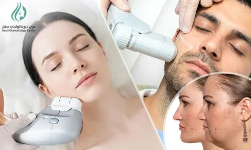 HIFU Skin Tightening for Ladies & Men at Aoun Dermatology Center!