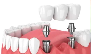 avenues-dental_-dealimage_health_acne-veneer-4copy.jpg