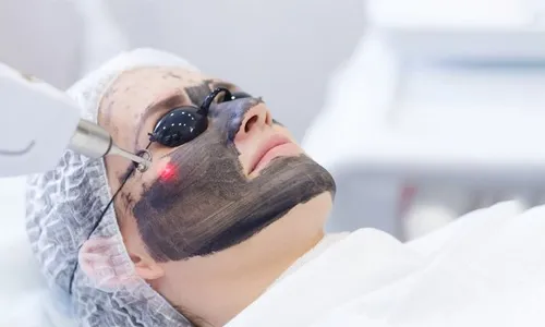 Carbon Laser Treatment for Face & Underarms at Reem Medical Center!