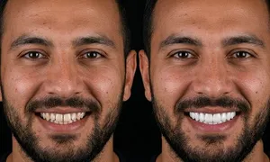 zone-medical-centre_dealimage_health-clinic_dental-implant-1.jpg