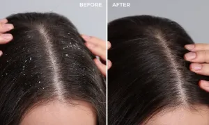 chic-hub-_deal-image_beauty-spa-_anti-scalp-1-copy.webp