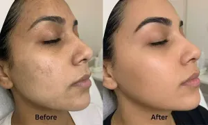 al-shami-medical-center_dealimage_health-and-clinic_carbon-laser-3-copy.webp