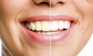 nesma-medical_dealimage_health-clinic_teeth-bleach-cop32.jpg