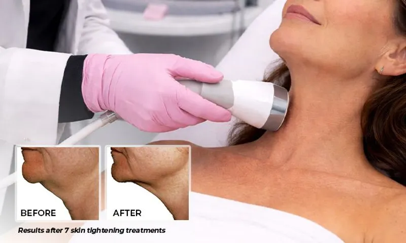 Tone, Tighten & Define with Venus Legacy Arms & Chin Contouring + Consultation for Ladies & Men!