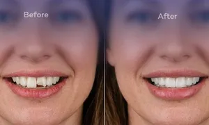 al-dana-dealimage_health-clinic-_-veneer-3filling.jpg