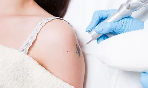dafna-medical_-dealimage_health_tattoo-removal-copy.jpg