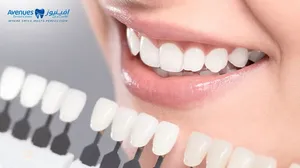 Hollywood Smile Veneers with Consultation!