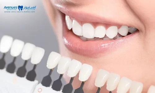 Hollywood Smile Veneers with Consultation!