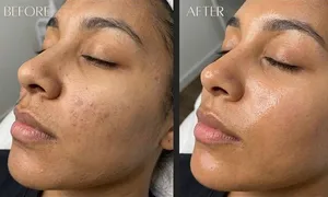 golden-gate-_deal-image_beauty-spa-_hydrafacial2.jpg