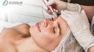 Advanced Skin Renewal Combo: Dermapen + Mesotherapy at Aoun Dermatology Center!