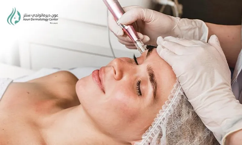 Advanced Skin Renewal Combo: Dermapen + Mesotherapy at Aoun Dermatology Center!