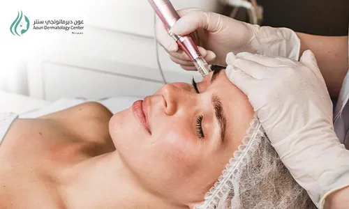 Advanced Skin Renewal Combo: Dermapen + Mesotherapy at Aoun Dermatology Center!